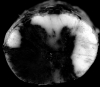 Intramedullary hemorrhage in a patient with vasculitis